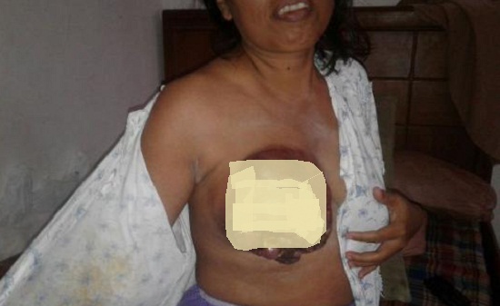 YA ALLAH...Kanker Payudaranya Sudah Demikian Parah, Warga Bukit Batu Ini Butuh Bantuan...