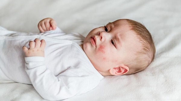 Kulit Wajah Bayi Memerah akibat Psoriasis, Ini Penyebab dan Cara Perawatannya...