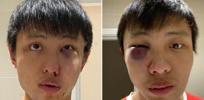 Seruan Bernada  Rasial Karena Corona Virus, Mahasiswa Singapura  Bonyok Dipukuli di London