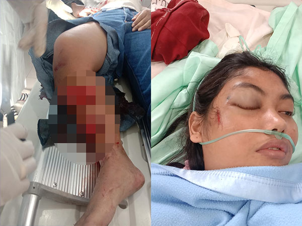 Brakkk! Tabrak Tronton, Mahasiswa Tewas Mengenaskan di TKP, Teman Wanitanya Luka Parah, Sopir Kabur