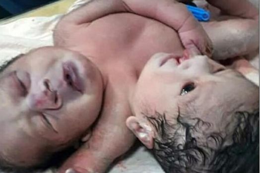 Syok Lahirkan Bayi 2 Kepala dan 3 Tangan, Suami Sedih, Sang Istri Pingsan