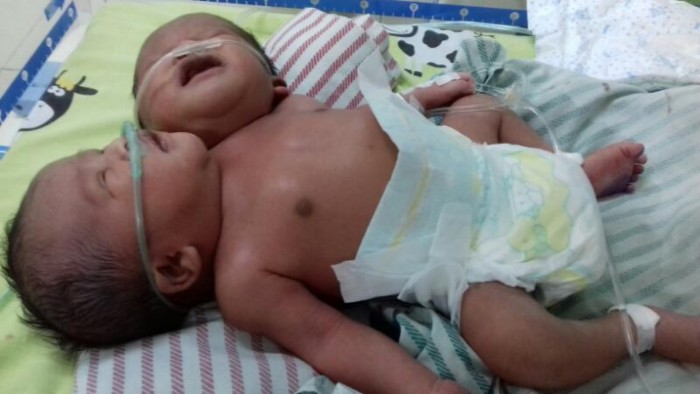 Bayi Kembar Siam Parapagus Ini Tak Bisa Dipisahkan, Liat Fotonya