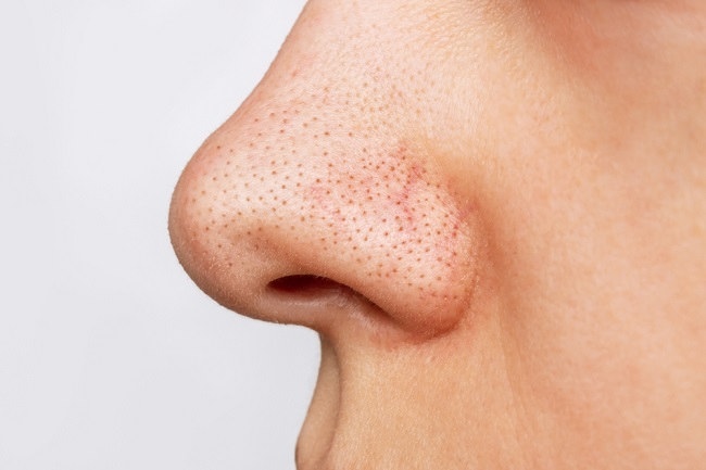 Cara Menghilangkan Komedo di Hidung secara Alami dan Permanen