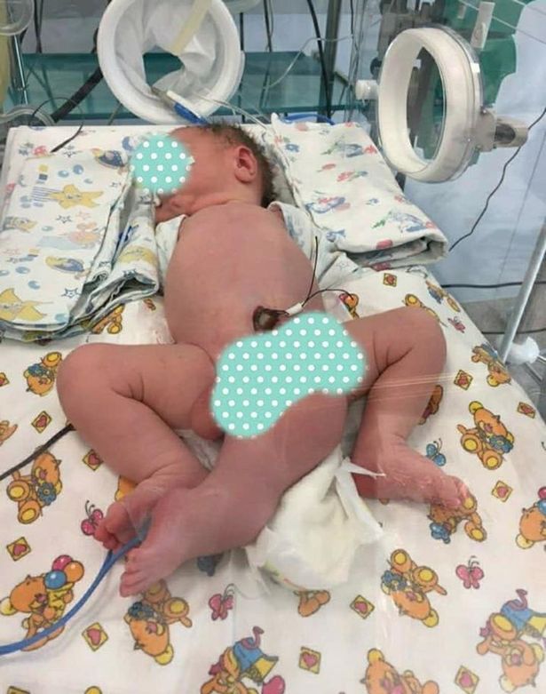 Langka! Bayi Ini Lahir dengan 3 Kaki dan 2 Penis dan Tanpa Anus