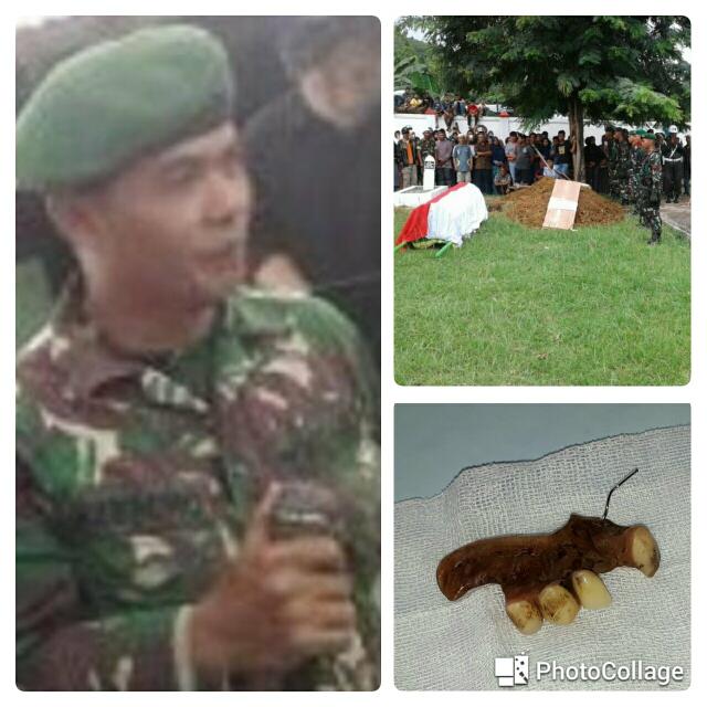 NAHAS...Telan Gigi Palsu, Anggota TNI Meninggal Dunia