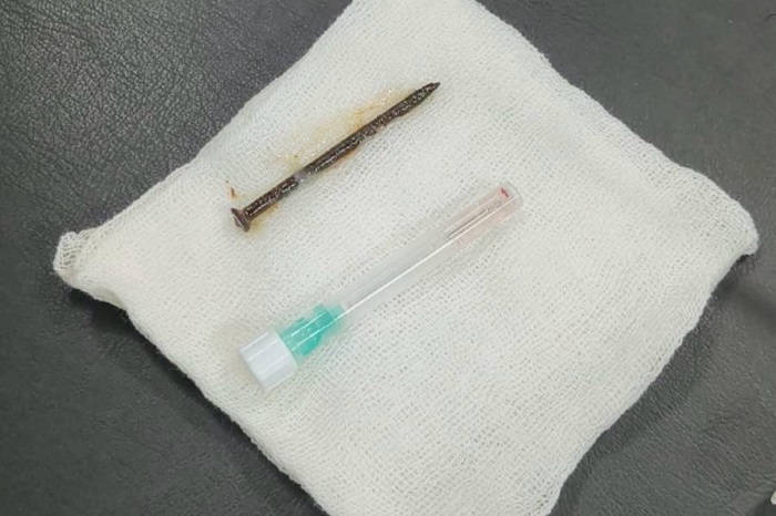 ANEH, Paku ini Ditemukan  di Dalam Paru-paru, Hebatnya,  Dokter Berhasil Keluarkan Tanpa Dibedah...