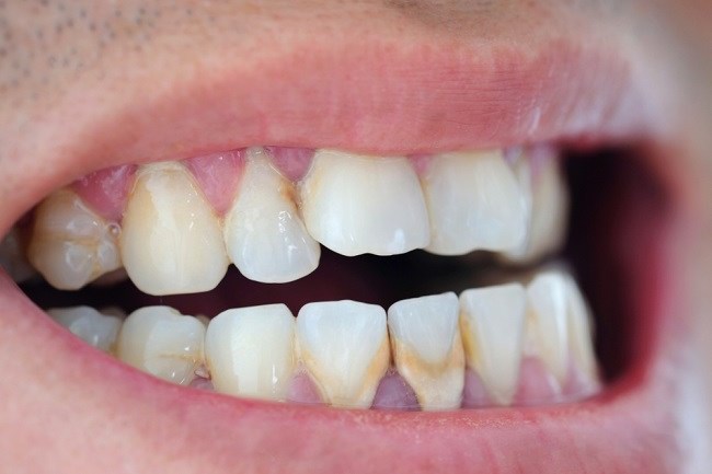 Cara Menghilangkan Kerak Gigi yang Efektif