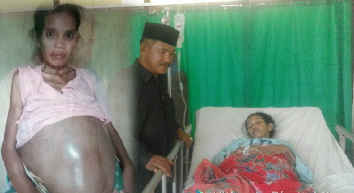 MOHON BANTUAN... Perut Romatin Membengkak, Butuh Biaya untuk Pengobatan