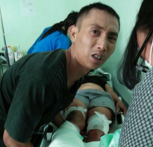 TRAUMA BERAT, Dipotong Suami, Ni Putu Tak Sadar Kalau Tak Punya Kaki Lagi