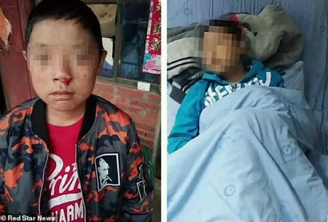 Aneh! Bocah 12 Tahun Ini Idap 'Penyakit Drakula', Kulitnya Terbakar jika Terpapar Sinar Matahari