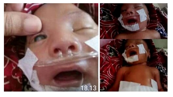 Bayi di Bengkalis Meninggal Karena Rubella, Lahir Dengan Katarak dan Bocor Jantung