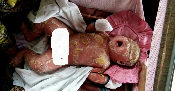 Bayi Malang Muhammad Alhafizi Divonis Menderita Penyakit Eritroderma