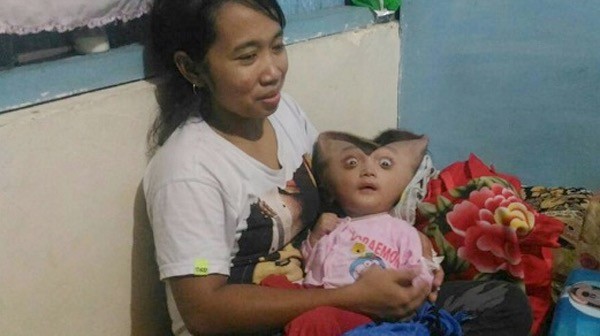 Ya Allah... Kasihannya...Karena Penyakit ini, Kepala Bayi Ahmad Mengempis Membentuk Love
