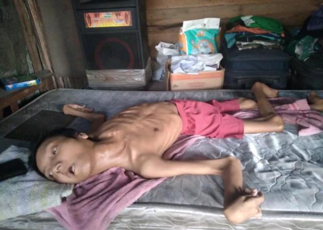 Sudah Puluhan Tahun, Penyakit yang Diderita Yundha Terus Menggerogoti Hingga Tubuhnya Semakin Mengecil