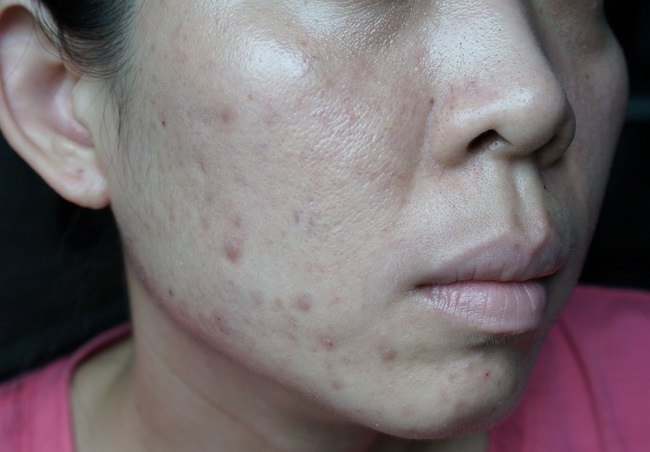 Cara Menghilangkan Bekas Jerawat Hitam di Pipi