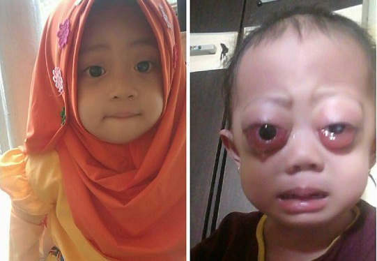 YA ALLAH... Kasihan Sekali, Bayi Cantik  di Riau, Hayfa Alesha Derita Penyakit Langka