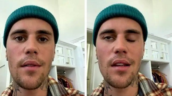 Sering Dengar Penyakit Lumpuh Setengah Wajah Seperti yang Dialami Justin Bieber, Ternyata Ini Penyebabnya...
