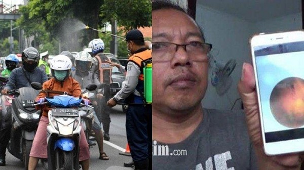 Pria Surabaya Alami Pecah Pembuluh Darah Mata. Katanya Sebelumnya Sempat Terkena Semprotan Desinfektan