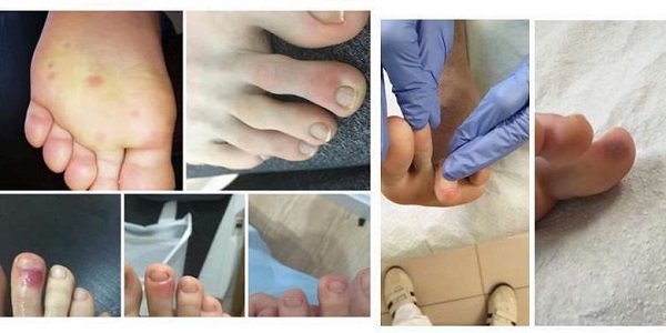 Warna Keunguan di Kaki Tanpa Sebab, Dokter Sebutkan Salah Satu Tanda Terinfeksi Corona