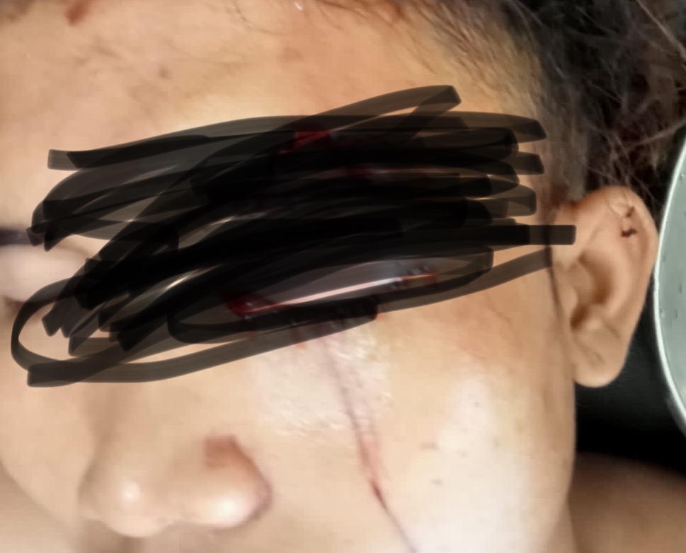 Cekcok Di Pakter Tuak Mata Frengki Di Tusuk Pakai Gunting