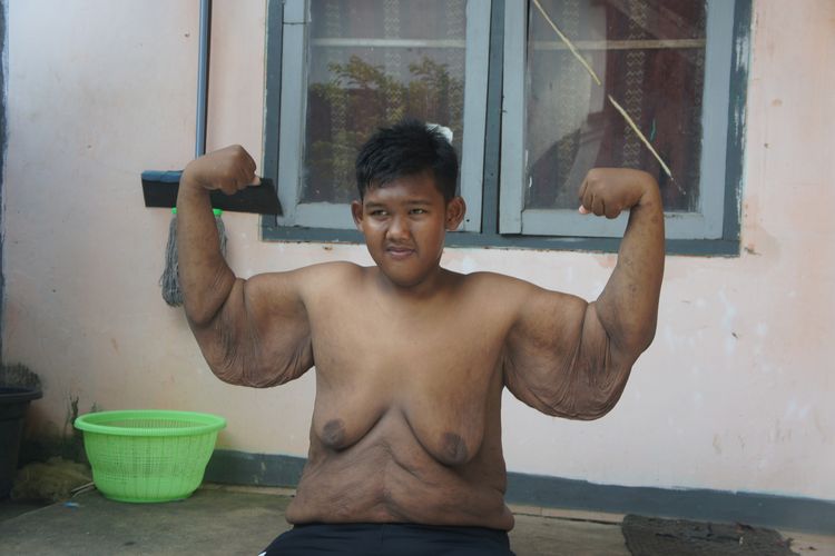 Besok, Arya Mantan Bocah Obesitas dengan Berat 192 Kg akan Jalani Operasi Gelambir