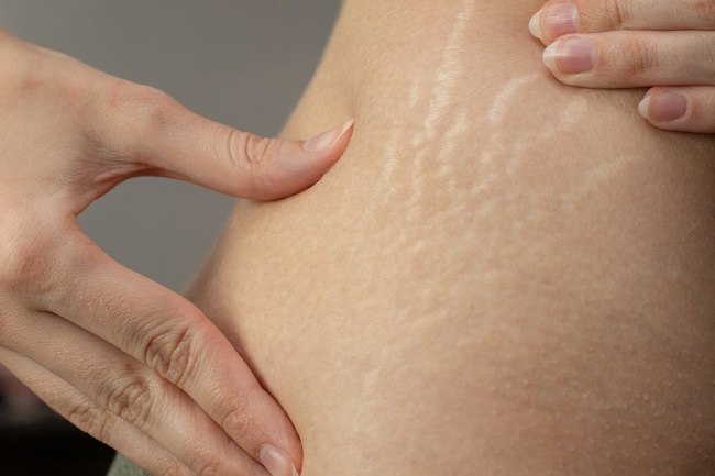 Cara Menghilangkan Stretch Mark secara Alami