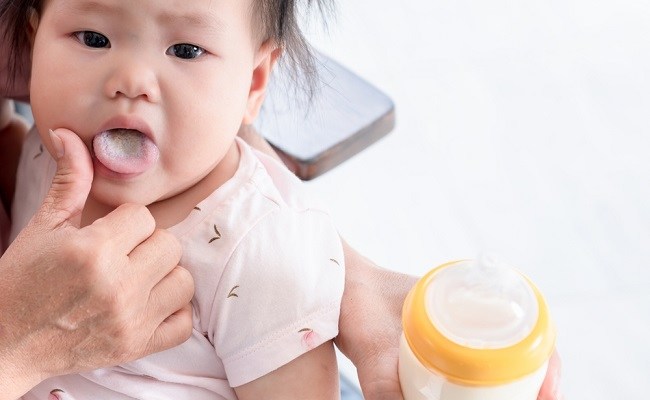Jamur pada Mulut Bayi, Ini Penyebab, Gejala, dan Penanganan