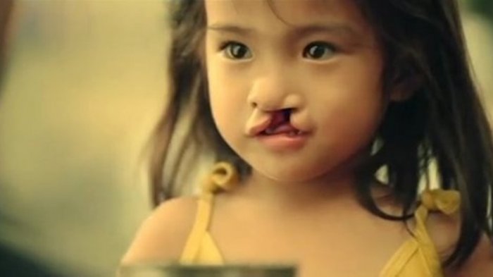Dibuang Semasa Kecil Karena Bibir Sumbing, Lihat Perubahan Gadis Ini Setelah Dewasa...