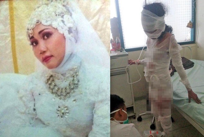 DIDUGA MALPRAKTIK... Usai Operasi Caesar, Nur Aini Alami Sakit Komplikasi, Ia Meninggal dengan Kulit Melepuh