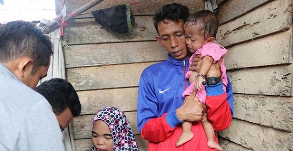 Zainal Tegaskan Bayi Natali Pasien Kurang Gizi Telah Ditangani Sejak Februari Lalu