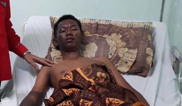 DUARRR...Kompor Meledak saat Dimatikan, Sebagian Tubuh Warga Dumai Ini Alami Luka Bakar