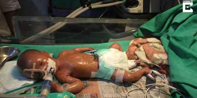 GEGER...Anita Devi Wanita Lahirkan `Bayi Plastik`, Kulitnya Mengkilat