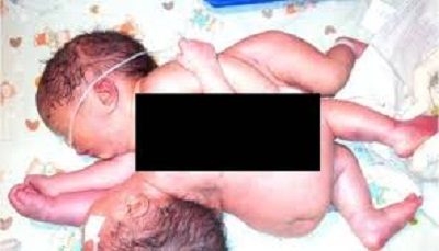 Innalillah...Bayi Kembar Siam Satu Jantung Meninggal Dunia di RSUD Arifin Achmad