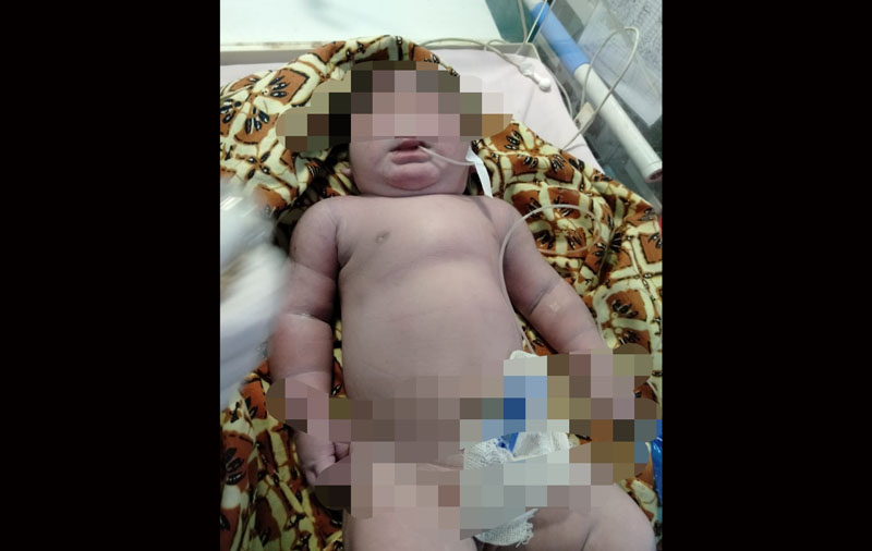 Geger! Bayi Perempuan Bermata Satu dan Tanpa Hidung Lahir di Siak-Riau, Tapi Umurnya Cuma Dua Jam