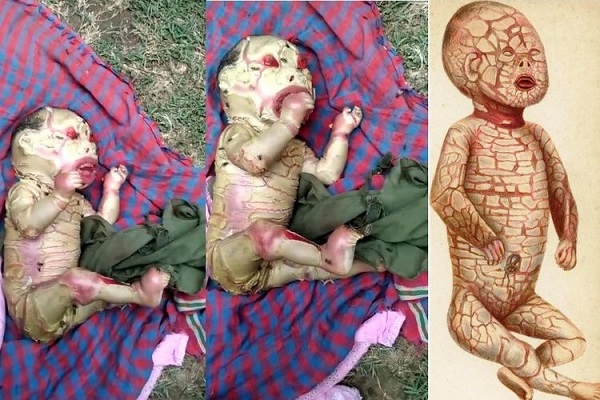 Makan Usus Ibunya Dan Disuntik 17 Kali Baru Mati, Kisah Bocah Kelainan Kulit Ini Faktanya!