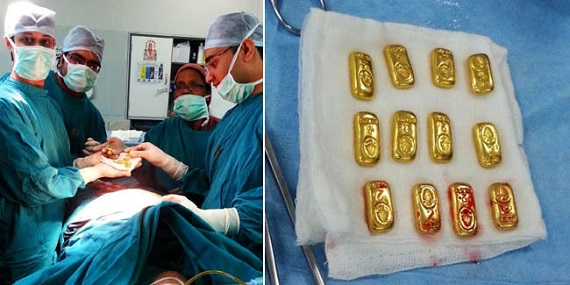 GEGER...Susah Buang Air, Dokter Bedah Temukan 12 Batangan Emas 400 Gram di Dalam Perut Pasien