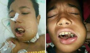 INNALILLAH...Hamzah Putra, Bocah Penderita Kanker Mulut Meninggal Dunia di RSUD Arifin Achmad Pagi Tadi
