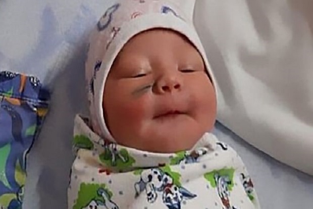 Kasihan! Tergores saat Operasi Caesar, Bayi Ini Lahir dengan Luka di Wajah, Ini Fotonya