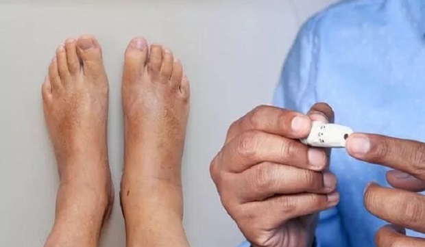 Tanda Diabetes di Kaki, 14 Gejala Ini  Harus Diwaspadai